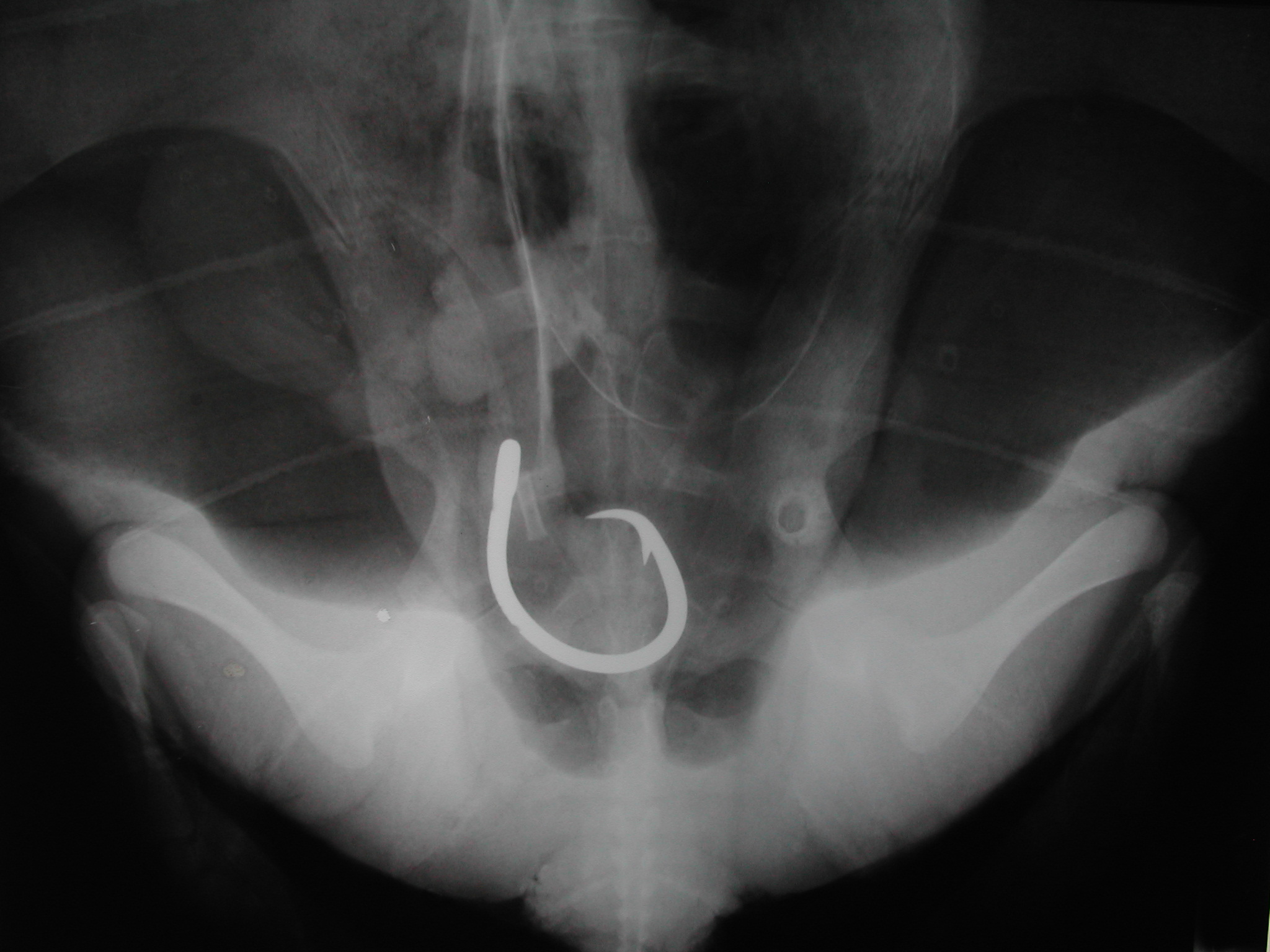 circle-hook-lower-intestine.JPG
